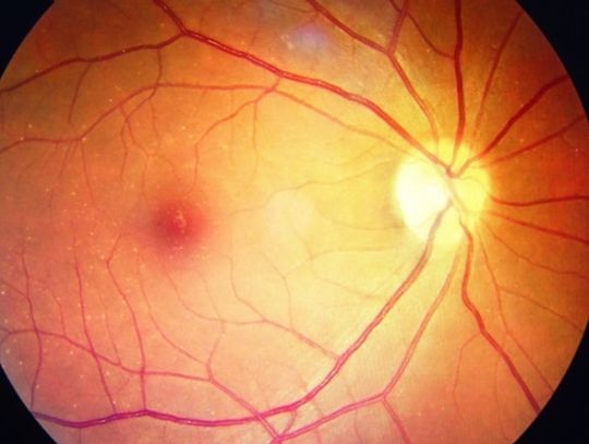 CUKRZYCA A CHOROBY OCZU – profilaktyka może uratować Twój wzrok