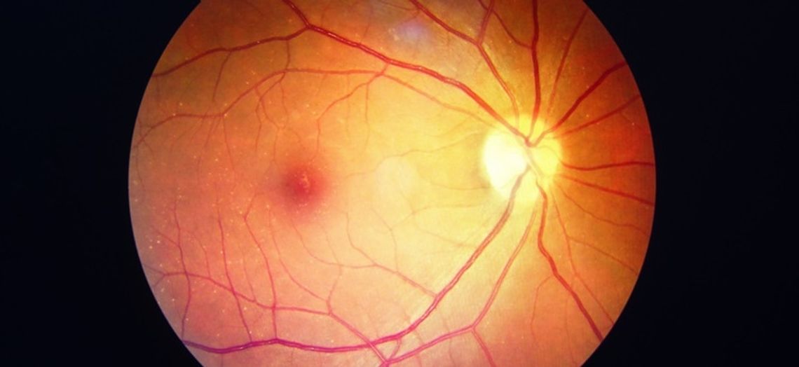 CUKRZYCA A CHOROBY OCZU – profilaktyka może uratować Twój wzrok
